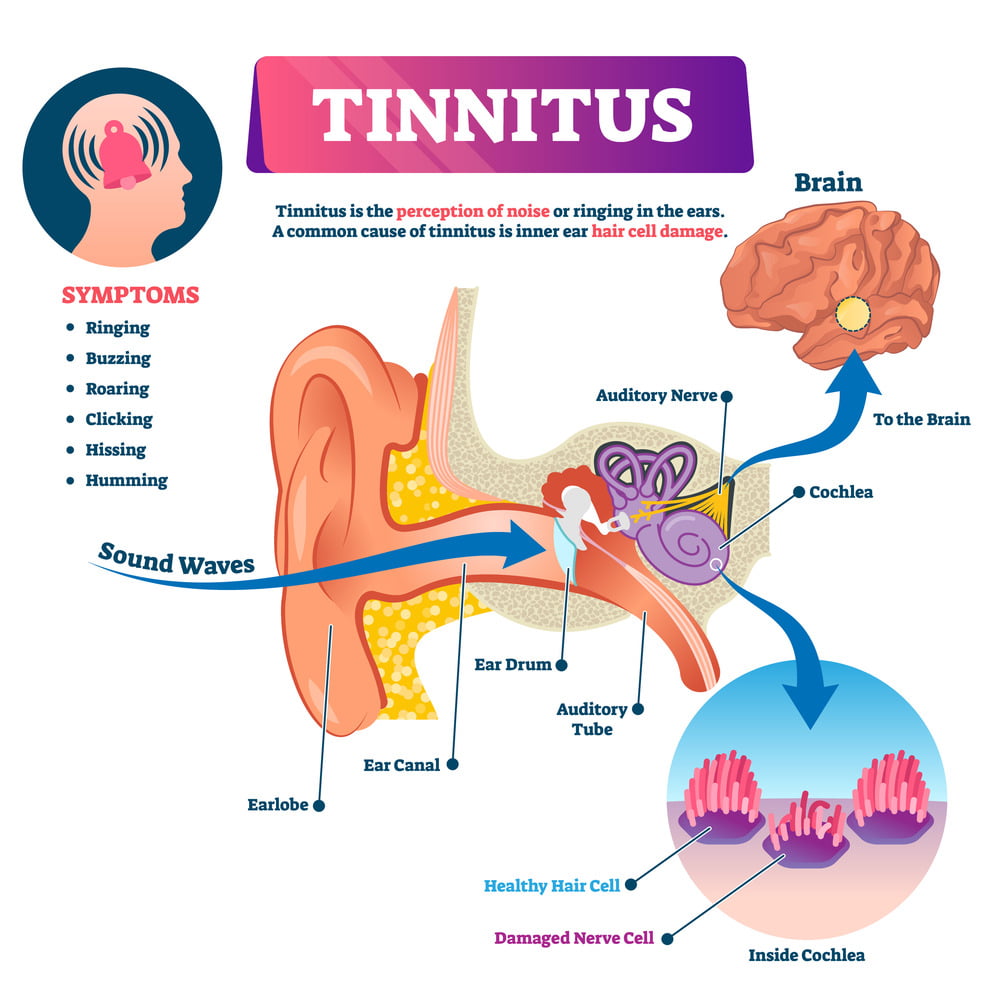 Tinnitus educational graphic